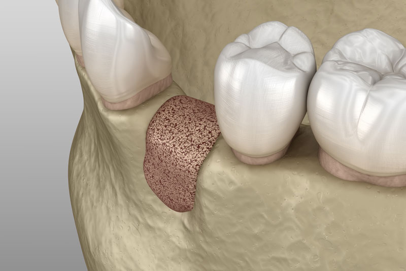 Bone grafting jaw bone example model.