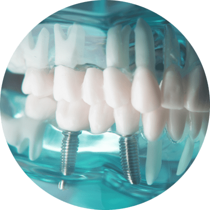 Dental implant example model