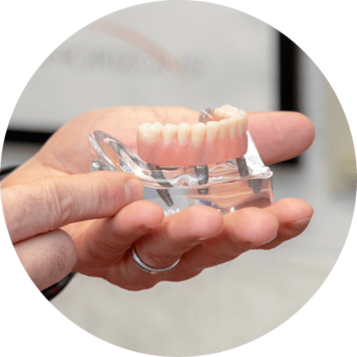 Dental implant surgery supported bridge.
