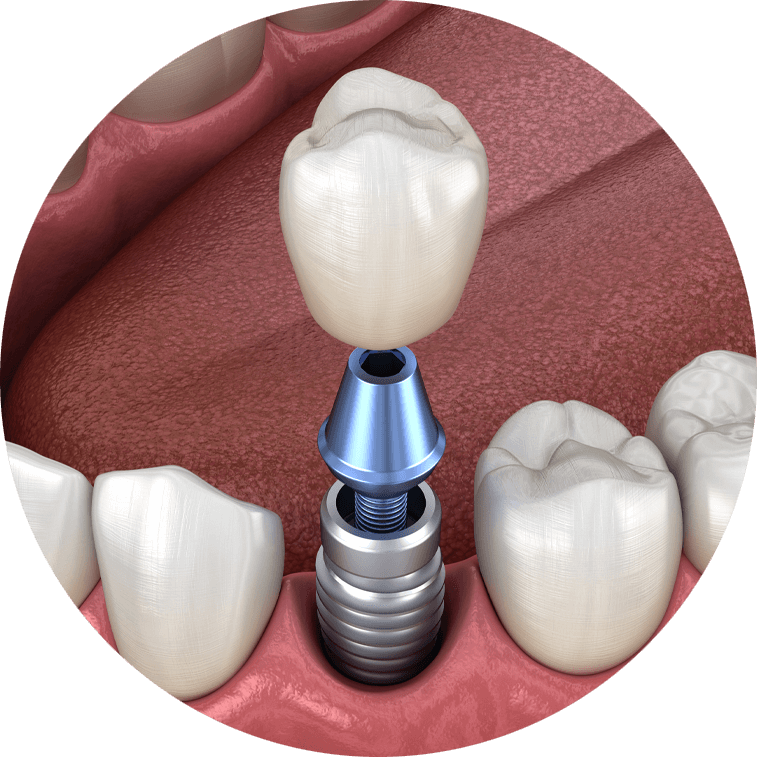 Single dental implant circle border.