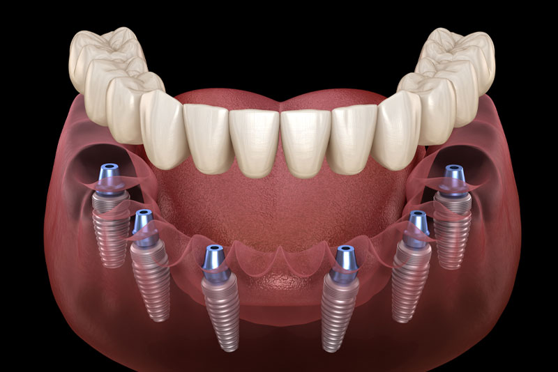 Fixed Teeth vs Removable full arch implant.