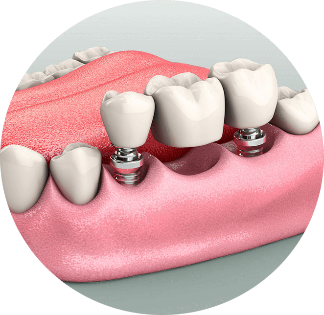 Implant supported bridge