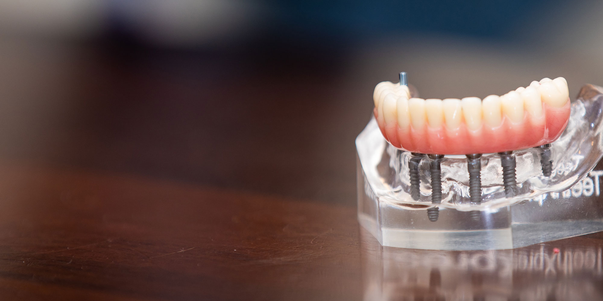 Full mouth dental implants