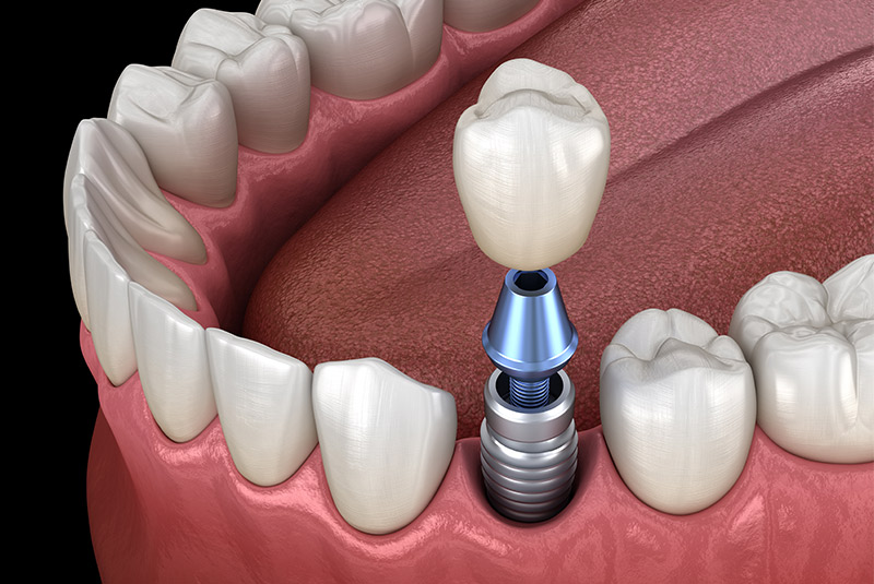 Single dental implant example model