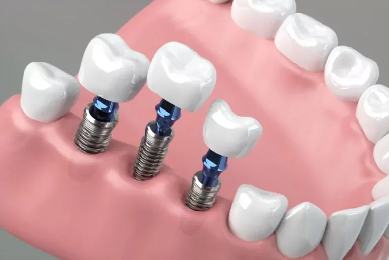 Dental Implants Teeth Replace Single