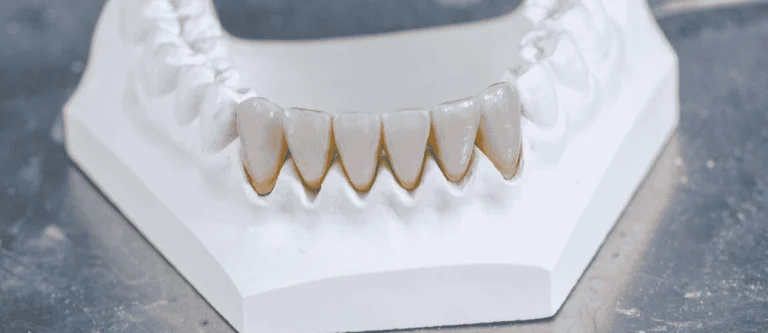 Acrylic-Titanium Hybrid vs. Monolithic Zirconia Full-Arch Bridges