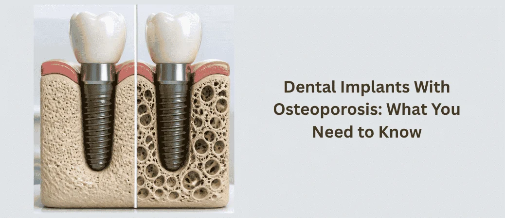 dental implants with osteoporosis