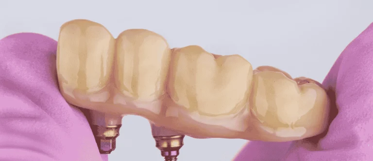 failing dental bridge