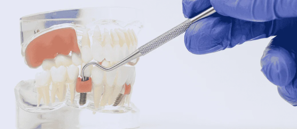 front vs back tooth implants