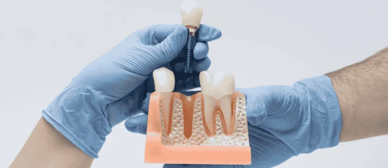 loose implant crown