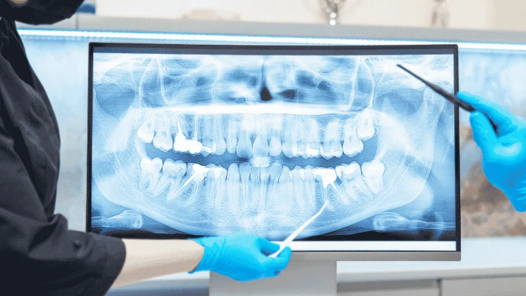 replacing a failed dental implant