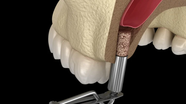 when is bone grafting needed for dental implants